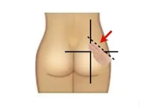 como-aplicar-injecao-intramuscular_4244.webp como-aplicar-injecao-intramuscular_4244.webp