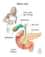 biliary-colic.webp