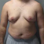 5 Severe Gynecomastia.webp