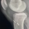 Tibial